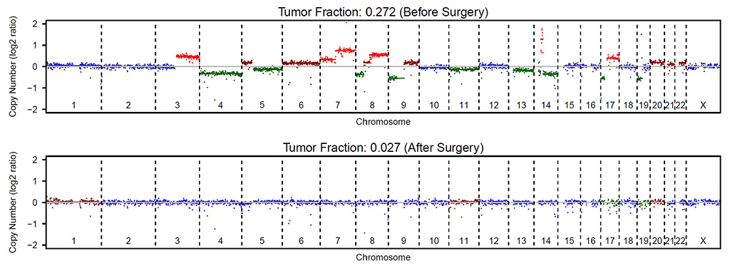 A representative example of circulating genome-wide copy number profiles in a hepatocellular carcinoma patient before surgery (Top) and after surgery (Bottom). The colors green, blue, dark red, and red correspond to copy number deletion, neutral, gain, and amplification, respectively.