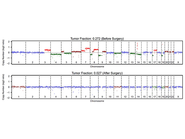 New Technology Shows Promise in Monitoring Hepatocellular Carcinoma: Circulating Genome-wide Copy Number Analysis