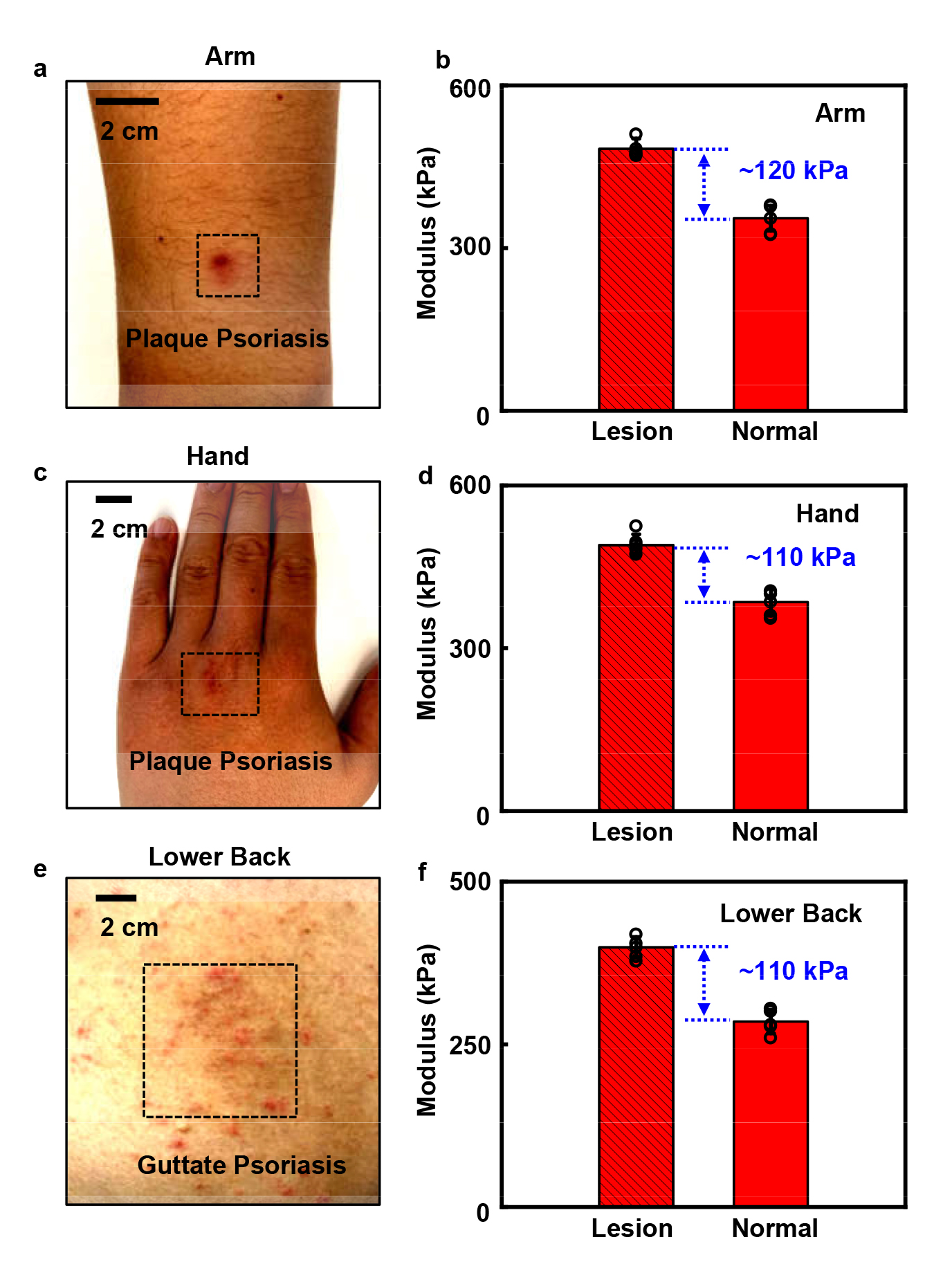 tissue stiffness 