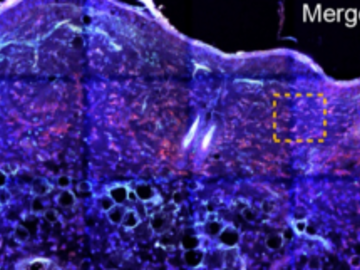 Hydrogel device enables painless transdermal delivery of nucleic acids